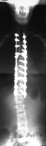neck exercises augusta, physiatrist augusta, anatomy library augusta, augusta neuroscience, surgical options augusta, surgical treatment options augusta, spine treatment augusta, spine treatment augusta, georgia physician, Augusta Back, Physical Medicine & Rehabilitation augusta, Andrew Forgay MD, Jean Marc Guitton MD, Gregory M Oetting MD, David L Baker DO, Dr Forgay augusta, Dr Guitton augusta, Dr Oetting augusta, dr baker augusta, augusta back, augusta neck, occupational medicine augusta, physical therapy augusta, Physical Medicine and Rehabilitation augusta, back pain augusta, neck pain augusta, physicians augusta, augusta spine surgery, georgia spine surgery, multidisciplinary augusta, physical therapy georgia, occupational therapy augusta, exercise gym augusta, nonsurgical treatment augusta, nonsurgical treatment georgia, spine care augusta, back pain georgia, neck pain georgia, back doctor augusta, back treatment augusta, back strain augusta, neck strain augusta, neurosurgeon augusta, spine doctor augusta, back physician augusta, injection therapy augusta, spinal injections augusta, back relief augusta, back pain prevention augusta, exercise library augusta, back exercises augusta, physiatrist augusta, therapist, injections, occupational therapy, spine center Augusta, Spine surgery second opinion augusta GA, spine surgeon Augusta, Second opinion for spine surgery Georgia, Spine surgeon Georgia, Laser spine surgery augusta Georgia, Minimally invasive spine surgery augusta, Home remedies for back pain augusta, Home remedies for back pain Georgia, nonsurgical treatment for back pain Georgia, Herniated disc treatment augusta Georgia, spinal injections Augusta, Artificial disc replacement augusta Georgia, Artificial disc replacement back Georgia, spine center of excellence Georgia, gym, neuosurgery augusta