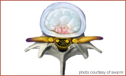 Stenosis