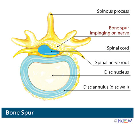 bone spur